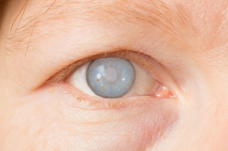 cataract